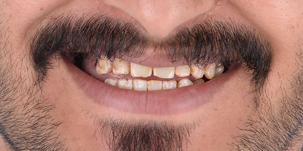Before