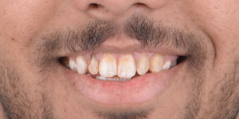 Before