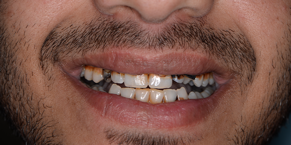 Before