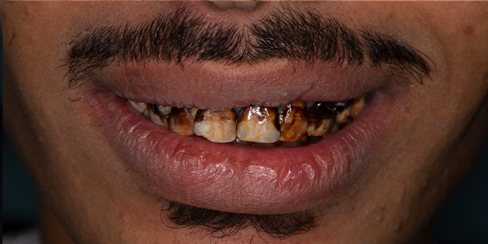 Before